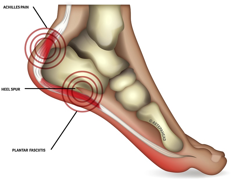 Pain in the Feet As a Symptom of Rheumatoid Arthritis