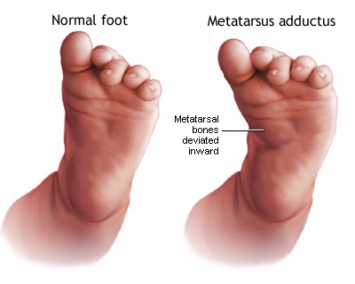 Metatarsus Adductus Or Banana Feet Stirling Central Podiatry