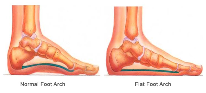 Flat Feet Or Pronated Feet (Paediatrics) - Stirling Central Podiatry
